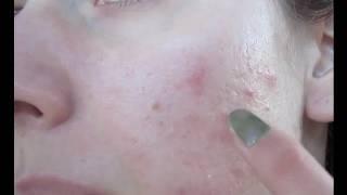 Acne Update! Skin Update! Journal + Face Diary + Dairy Free For Acne