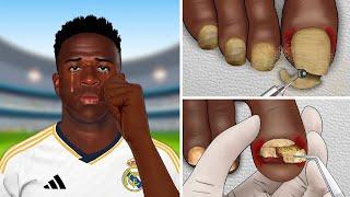 ASMR Vinícius Jr treat his feet | perennial toenail removal