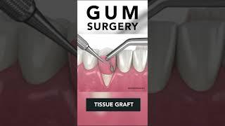 Receding Gums Surgery