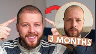 Should you get a hair transplant? | MY 3 MONTH RESULTS @SmileHairClinic