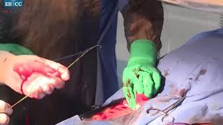 LiveTAVI/TAVR step by step procedure at Eternal Hospital, Performed 3800+TAVI procedure collectively