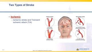 Ischemic Stroke | Lisa Klein