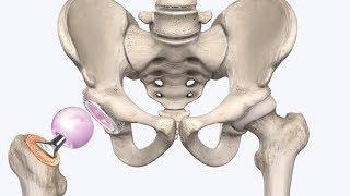 Замена тазобедренного сустава - sustavy.od.ua