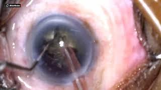 Phacoemulsification in Hard cataract  by Dr. Fahad, NIO