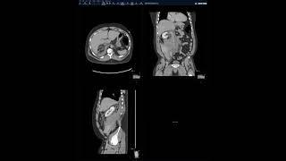 Abdominal Case Conference - 2/2/2021