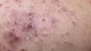 Huge blackhead removal from nose /old aged blackheads removal /  blackheads new this week 2023 /6