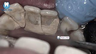 Can You Watch Till the End? Top 3 Most Shocking Tartar Removals!#125