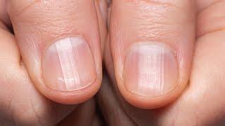 If You Have Ridges On Your Fingernails It Means This