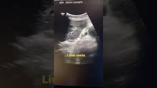 liver mets#imaging #ultrasound #medicalimaging #learning #cancer #viral