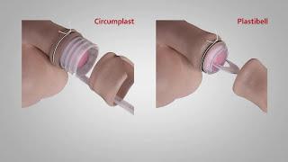 A comparison of Circumplast® and Plastibell® Circumcision Devices