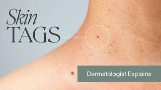 How To Treat Skin Tags | According to a Dermatologist