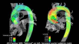 4DMRI - Bicuspid Aortic Valve