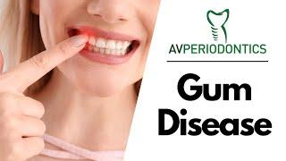 Gum Disease - Manhattan, NY - Dr. Alexander Volchonok