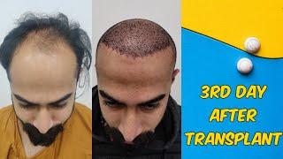 Hair Transplant 3-7days result | Best Cost &Results of Hair Transplant in indore