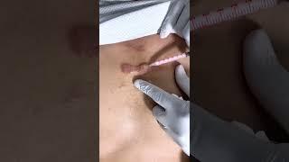 How to treat keloid scar | Keloid Removal Treatment | Remove keloid by injection |  Skinaa Clinic