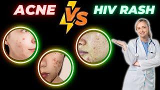 Does HIV Rash Resemble Acne ?