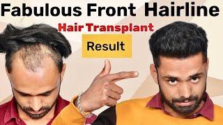 Front Hairline Hair Transplant Result | Most Common Problem & Permanent Solution by Hair Transplant