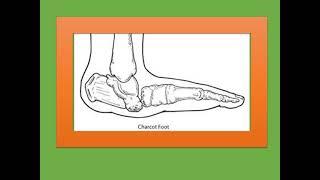 Mnemonics for NEET PG ORTHOPEDIC-Charcot's joint