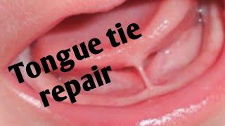 Treating tongue-tie ||  #whatilearntoday || Ankyloglossia