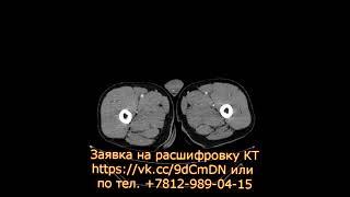 Заключение по КТ грудной клетки показало очаговое поражение правого легкого