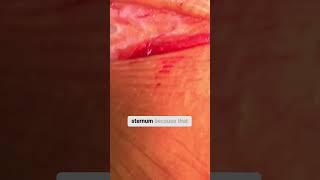 How to Perform an Upper Ministernotomy #Cardiac #Sternotomy #CTSNet