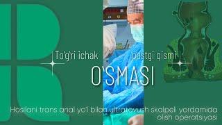 To'g'ri ichak pastgi qismi o'smasini trans anal yoʻl bilan ultratovush skalpeli yordamida olish