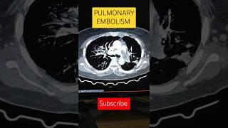 pulmonary embolism #radiology #pulmonary #angiography #embolism #lungs  @hemantkushwah3453