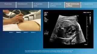 Key screening views of the fetal heart -  Part 5 -  Right ventricular outflow