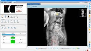 OrthoFix Cage Tool