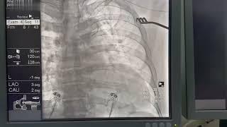 Pacemaker implantation in left superior vena cava – Video S1 [509860]