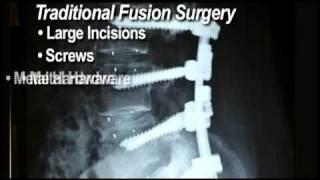 Deuk Spine Institute - Open Back Surgery vs Laser Disc Repair Broadcast