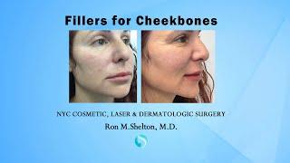 How to have #CheekFillers and Look Natural - Ron Shelton M.D. NYC