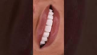 Start your Smile Makeover today!!! With Dr. Tejas Patel #veneers #cosmeticdentistry #smiles