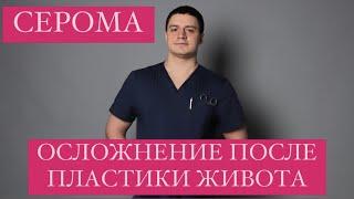 Осложнение после пластики живота - серома Абдоминопластика Диастаз Пластика Пластический хирург