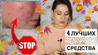 КАК ИЗБАВИТЬСЯ ОТ ПОДКОЖНЫХ ПРЫЩЕЙ ЗА 1 ДЕНЬ / 4 ЛУЧШИХ КОПЕЕЧНЫХ СРЕДСТВА