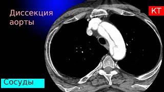 Лучевая диагностика расслоения (диссекции) аорты