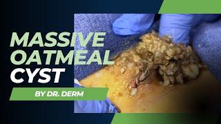 Massive Oatmeal Cyst with sack removal | Dr. Derm