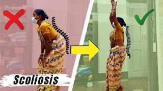 Amazing Recovery *Scoliosis* Chiropractic Treatment! | Dr Sanjay Sarkar (USA) | Call 9903026262