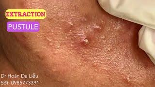 Nặn mụn nhọt khủng vùng cổ mặt siêu to|Squeeze big pimples, hidden acnes Dr Hoan 0985773391