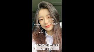 [Plastic Surgery in Korea] Jaw Dropping Beautiful Changes After Plastic Surgery in Korea #shorts