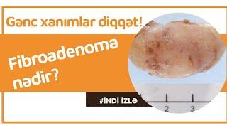 Gənc Xanımlarda Yaranan Fibroadenoma Nədir? I Müalicədən Sonra Yenidən Əmələ Gələ Bilərmi?