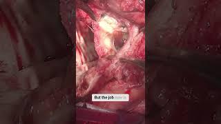 Redo AVR and Ascending Aortic Replacement With LVOT Enlargement Due to Endocarditis #avr  #series