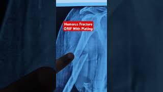 Humerus Fracture ORIF With Plating Dr Sai Chandra