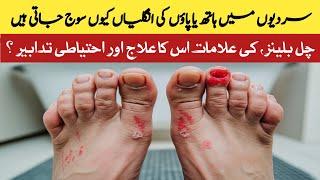 Chilblains Symptoms and Remedies || Protect Your Skin This Winter || Dr. Kashif Bilal