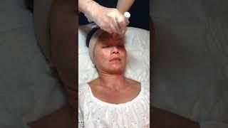 Microneedling/PRP Demonstration