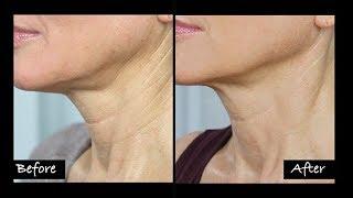 My Experience Getting Ultherapy | Non-Surgical Neck Lift? | Before & After