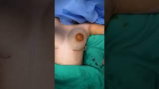 Breast Implant Surgery Before & After Result #shorts #shortvideo