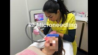 RF Microneedling and How Can It Help Your Skin | Experience Dr Cosmetist