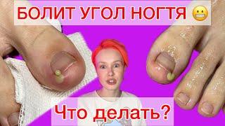 GROWN NAIL | WHAT TO DO? | CORNER HURTS | GROWN TOENAIL #alena_lavrentieva #nails