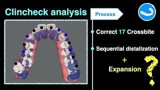 Expansion in Aligners｜【Chris Chang Ortho】CC812